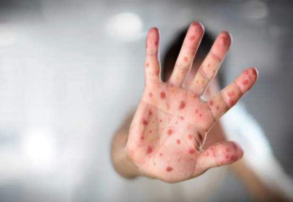 Mii de cazuri de rujeolă, după scăderea ratei de vaccinare
